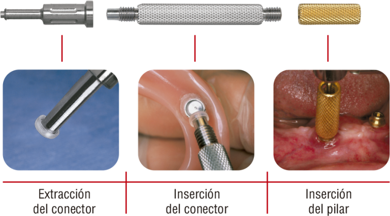sistema-locator-dentalmax-sa